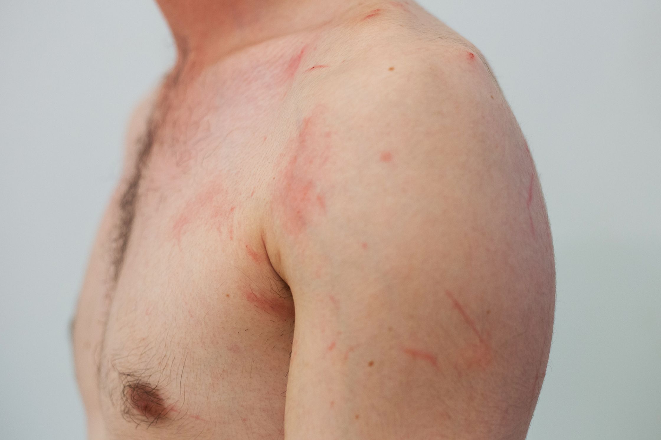 A shirtless man's chest and shoulder are covered in red skin rashes of different sizes.