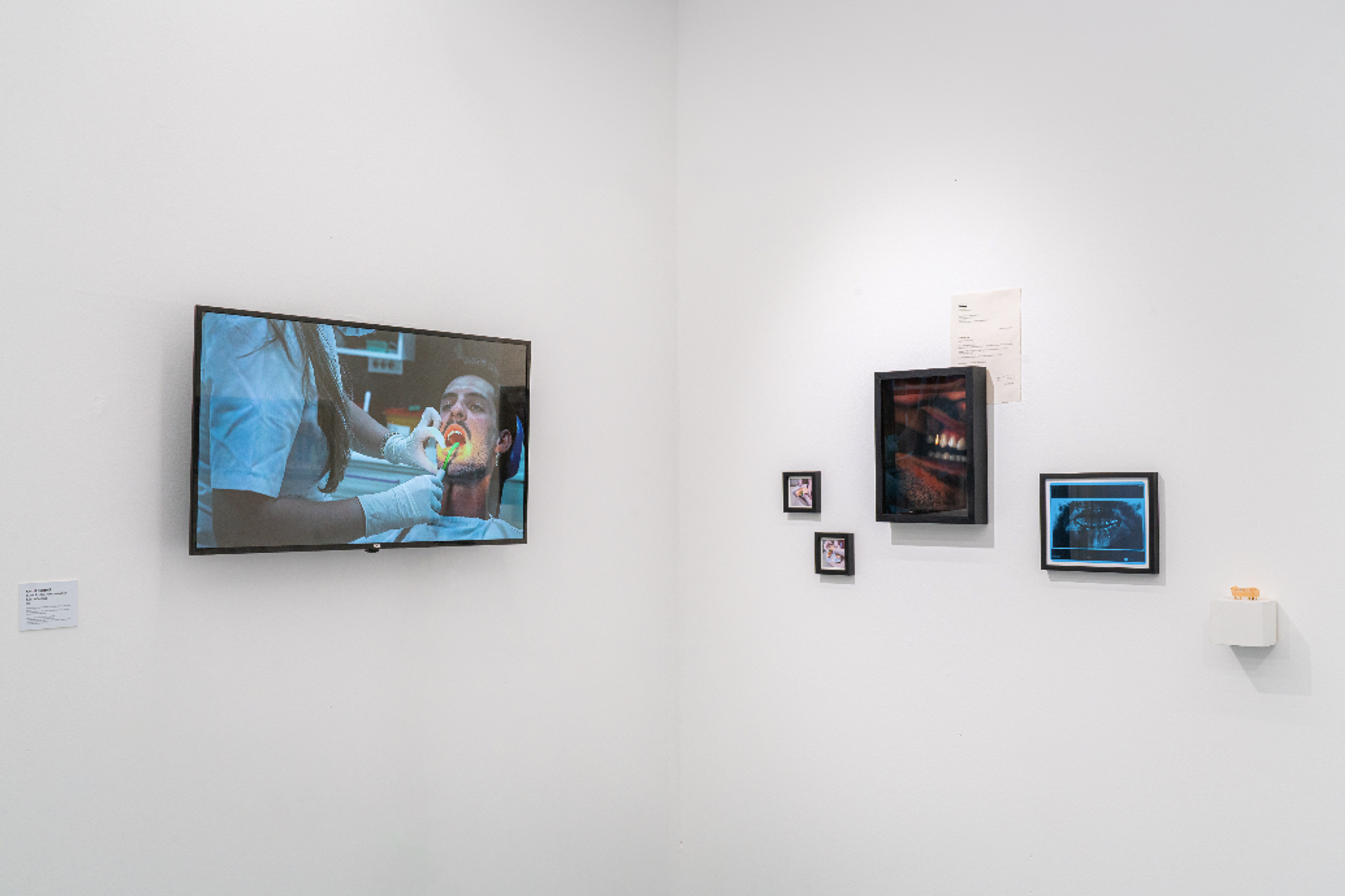 A TV screen displaying a dental procedure hangs on a white wall next to a collage of framed dental-themed imagery and a small white shelf with an object.