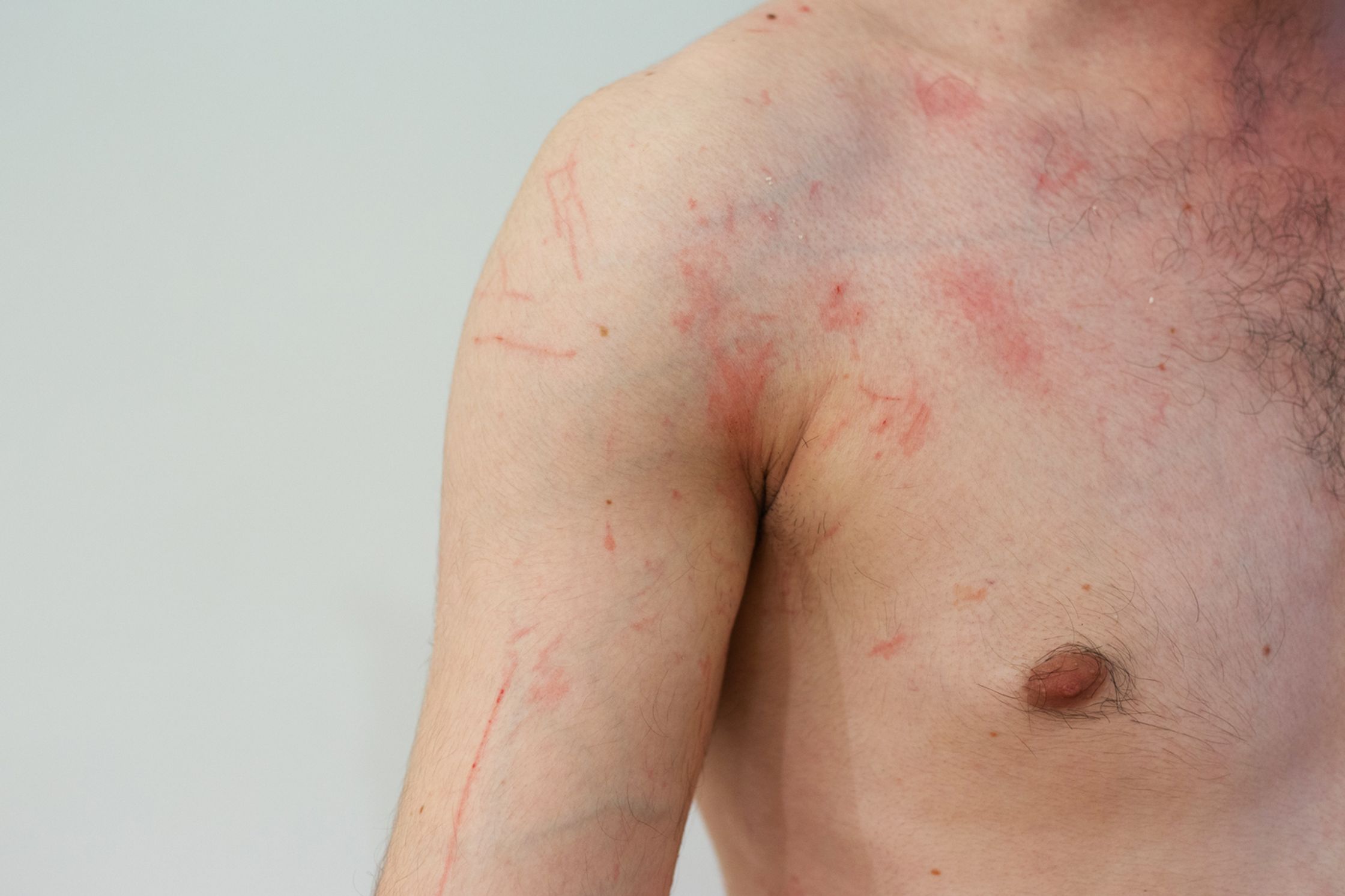 Bare chest and shoulder of a person with dermatographia or skin writing on their skin.